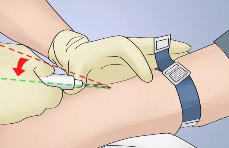 Горячий укол для чего его делают внутривенно. Горячие уколы. Горячий укол для чего его делают внутривенно. Внутривенное введение лекарственных средств. Горячий укол для чего его делают внутривенно.