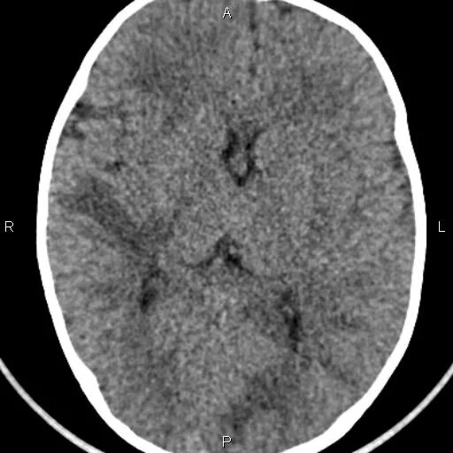 Лейкоэнцефалит