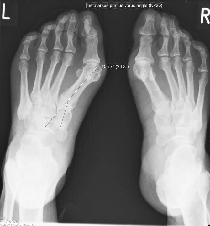 Степени вальгусной деформации. Hallux valgus степени рентген. варусная деформация стопы рентген. вальгусная деформация стопы рентген степени. вальгус степени рентген.