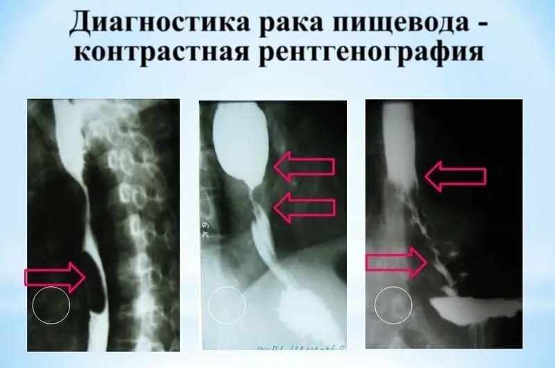 Рентгенологическое исследование пищевода. Рентгенограмма пищевода. Рентгенограмма контрастированного пищевода. Контрастная рентгеноскопия пищевода. Анализ пищевода