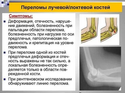 Кости становятся крепче после переломов