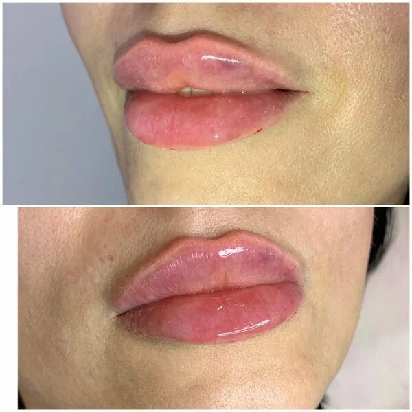 Формы губ. Губы техника тп расшифровка. Тп техник. Тп техник. Губы тп техника емельян брауде.