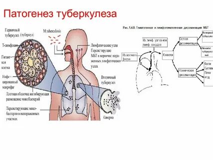 Анатомия туберкулеза