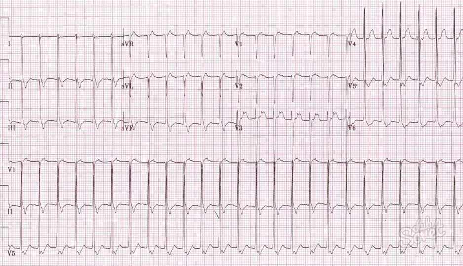 ЭКГ наджелудочковой тахикардии. Пароксизмальная наджелудочковая тахикардия ЭКГ. Суправентрикулярная пароксизмальная тахикардия на ЭКГ. Наджелудочковая тахикардия на ЭКГ. Мв на экг