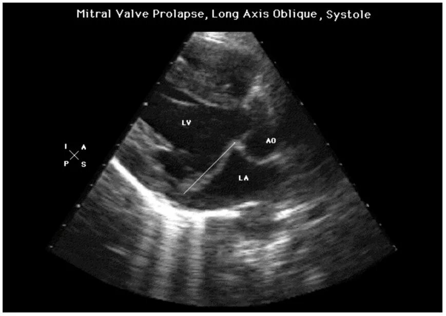 Дегенерация митрального клапана. Пролапс митрального клапана на УЗИ сердца. Отрыв хорды митрального клапана на УЗИ. Пролапс митрального клапана на Эхо. Пролапс митрального клапана по ЭХОКГ.