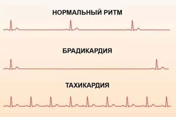 Норма пульса у женщин по возрасту таблица. Сердцебиение 25 лет. Брадикардия норма тахикардия. Пульс 64 удара в минуту у женщин это норма. Норма частоты сердечных сокращений в 40 лет.