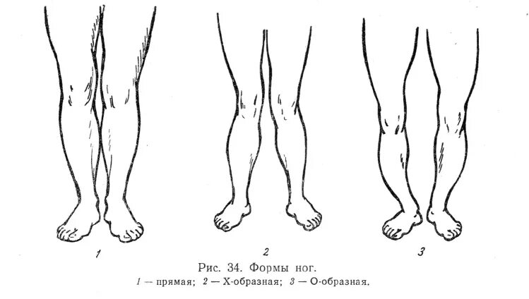 Развитие нижней конечности. Варусная деформация для кривых ног. Форма ног соматоскопия. Варусная деформация голени. Варусная деформация голень измерения.