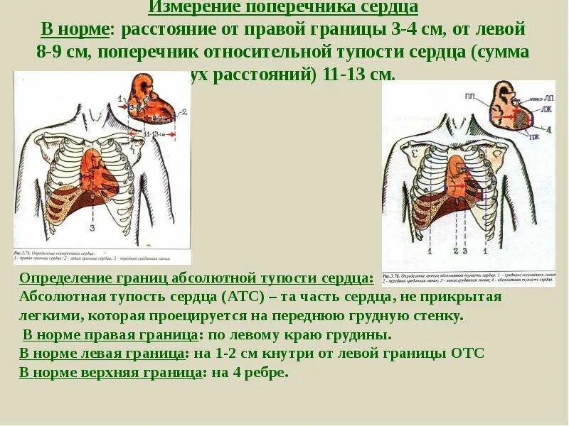 Что значит расширен поперечник сердца. Длинник и поперечник сердца. норма длинника и поперечника сердца. длинник и поперечник сердца у детей. границы абсолютной тупости сердца в норме.