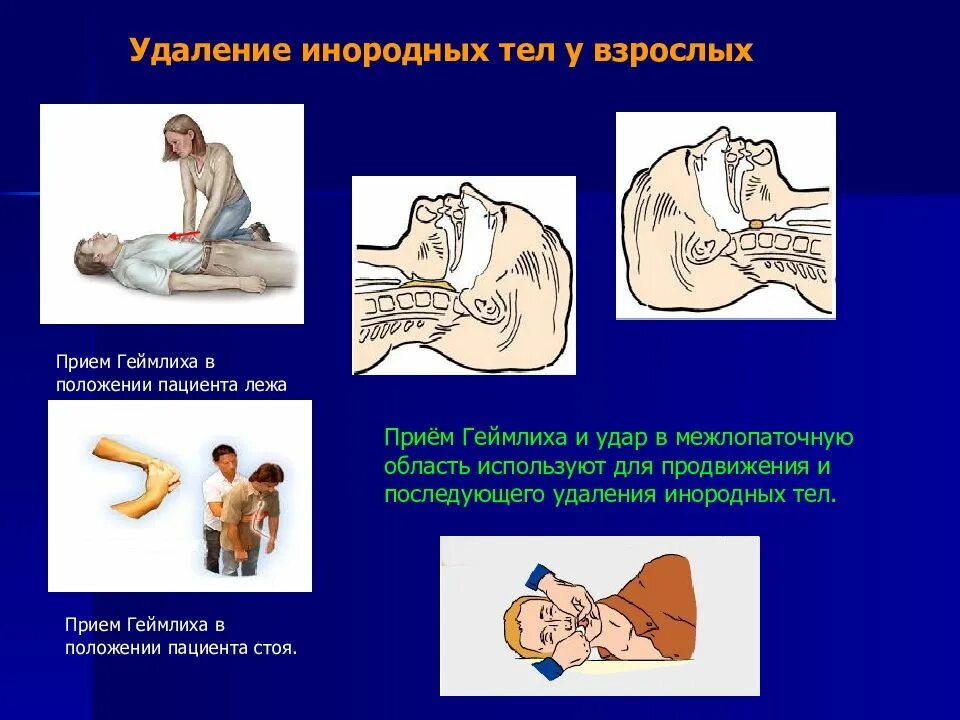 Приемы удаления инородных тел
