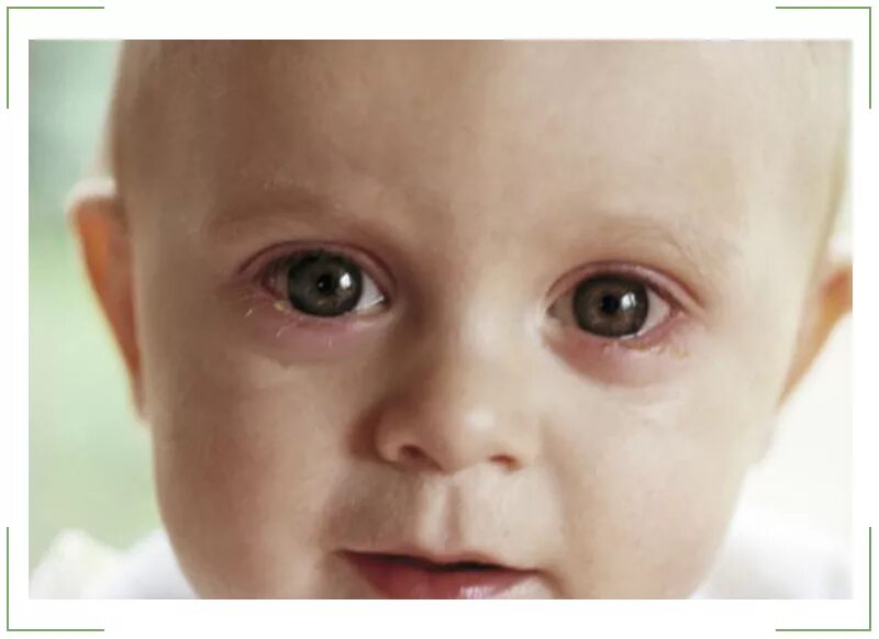 Коньюктивит у ребенка 7. Хламидийный конъюнктивит (паратрахома) новорожденных. Гонококковый конъюнктивит новорожденных. Поллинозный конъюнктивит. Конъюнктивит у грудничка.