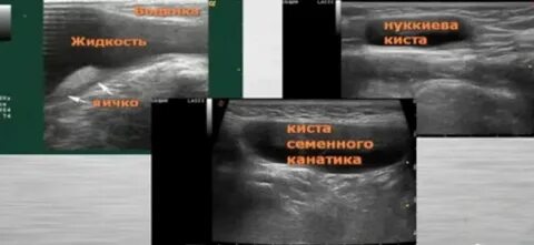 Причина паховой грыжи у мальчиков