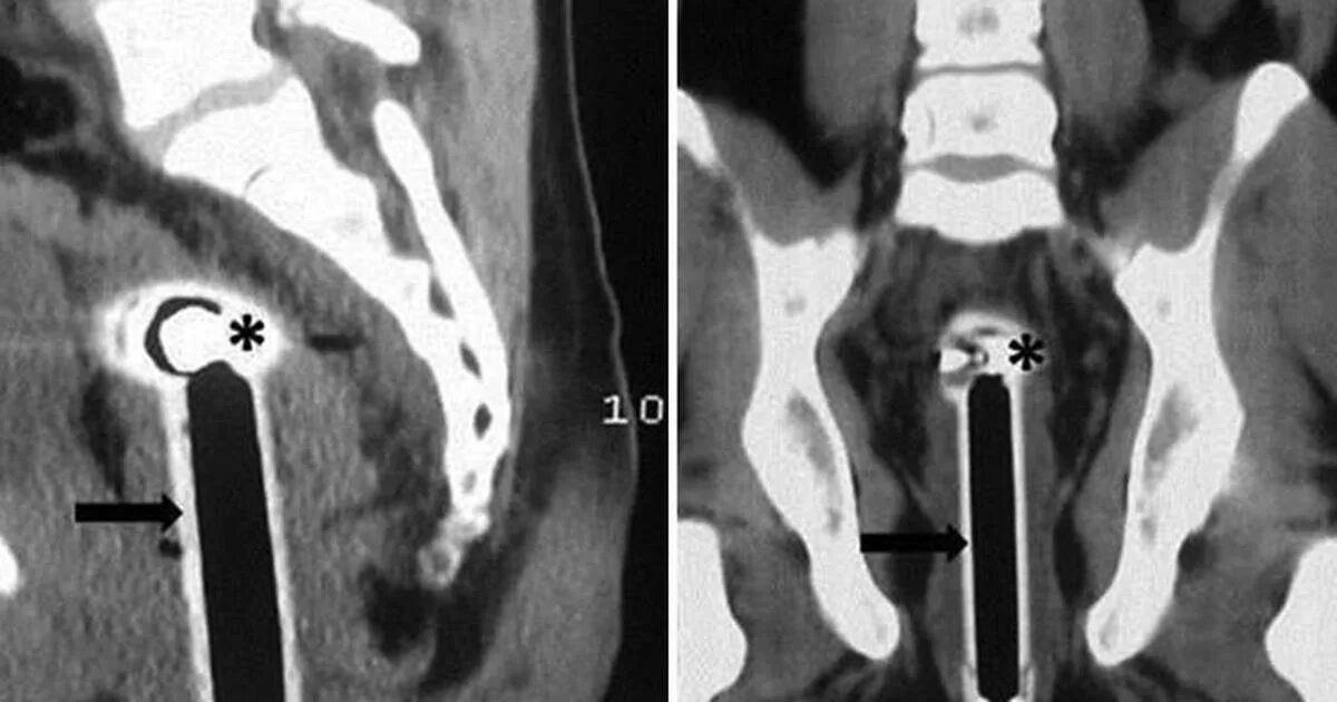 Ощущение инородного тела в носоглотке. Повреждение прямой кишки причины. Ощущение инородного тела в носоглотке. Выпадение геморроя узлов. Онкология прямой кишки симптомы.