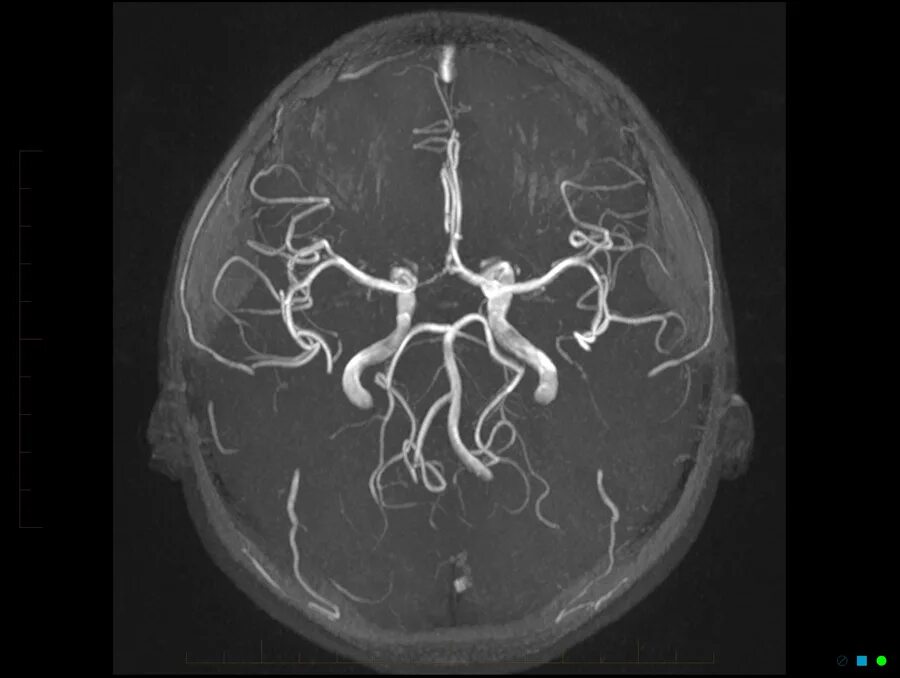 Венография головного мозга. Ангиография сосудов головного мозга. Коронарография сосудов головного мозга. Магнитно-резонансная ангиография. Мрт ангиография сосудов головного мозга.