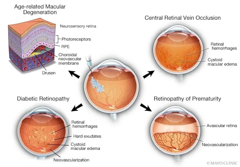 Age related Macular Degeneration Dry form. Macular hole по GASЫ classification.