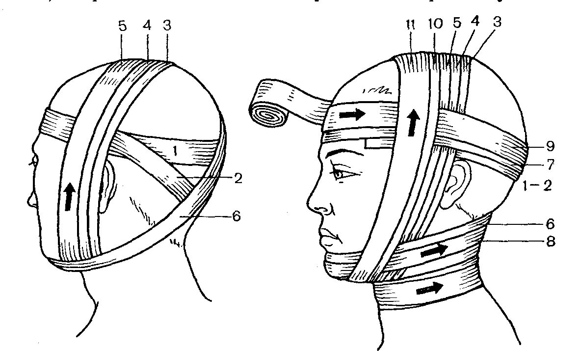 Как перевязывать голову. Уздечка техника наложения. Наложение повязки уздечка. Десмургия повязка уздечка. Повязка уздечка алгоритм.