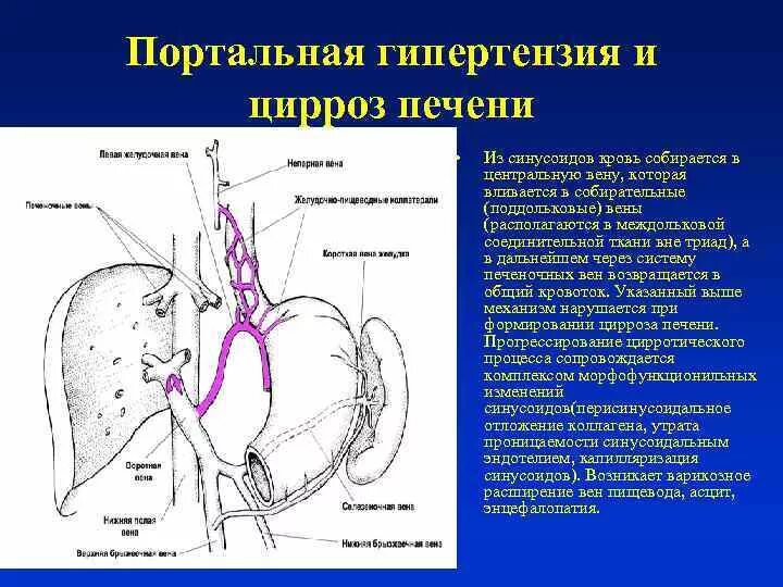 Печень расширены вены. Портальный цирроз печени патогенез. Воротная Вена при циррозе печени. Портальная гипертензия при циррозе печени. Подпеченочная портальная гипертензия.