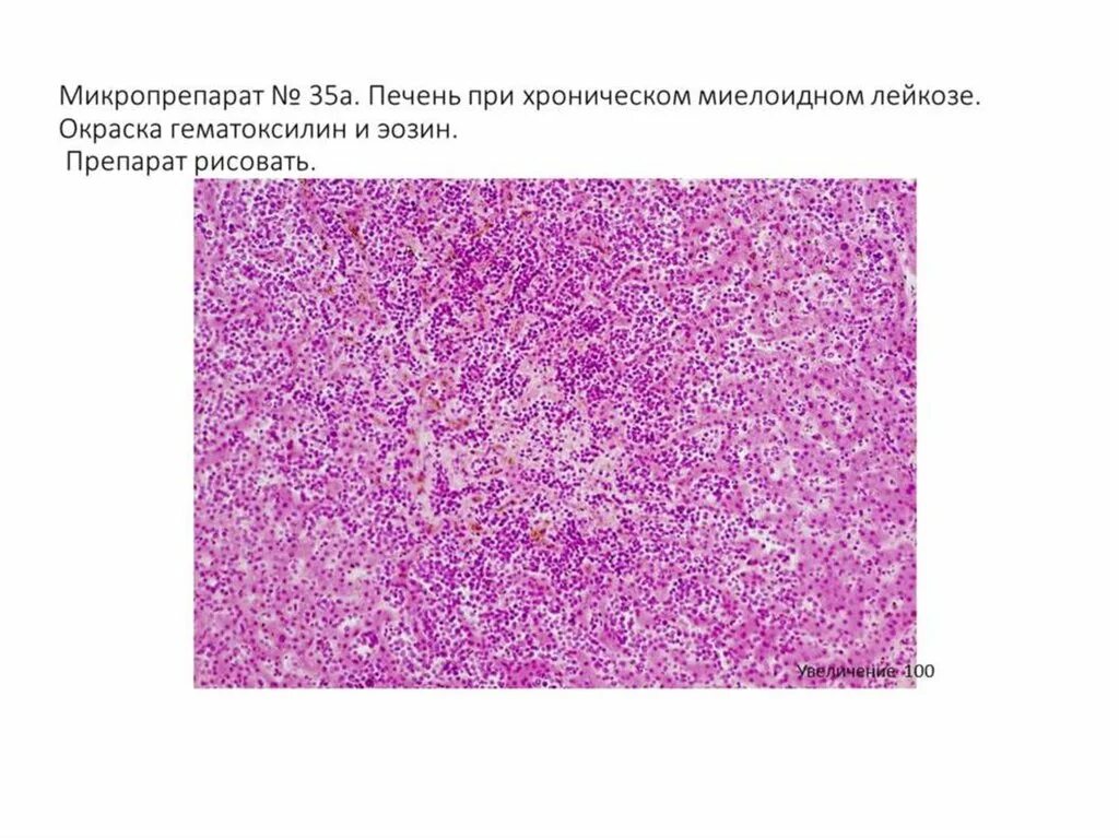 Печень микропрепарат описание. Патанатомия головной мозг при острый миелолейкоз. Острый миелобластный лейкоз патанатомия. Мозг при остром лейкозе микро. Лейкозная инфильтрация печени микропрепарат.