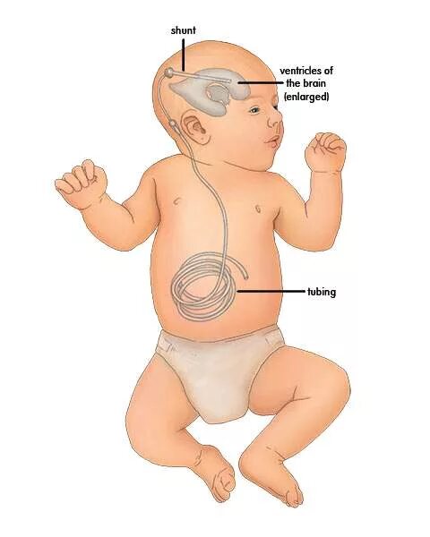 Шунт в голове у новорожденного. Вентрикулоперитонеостомия. Как выглядит шунт