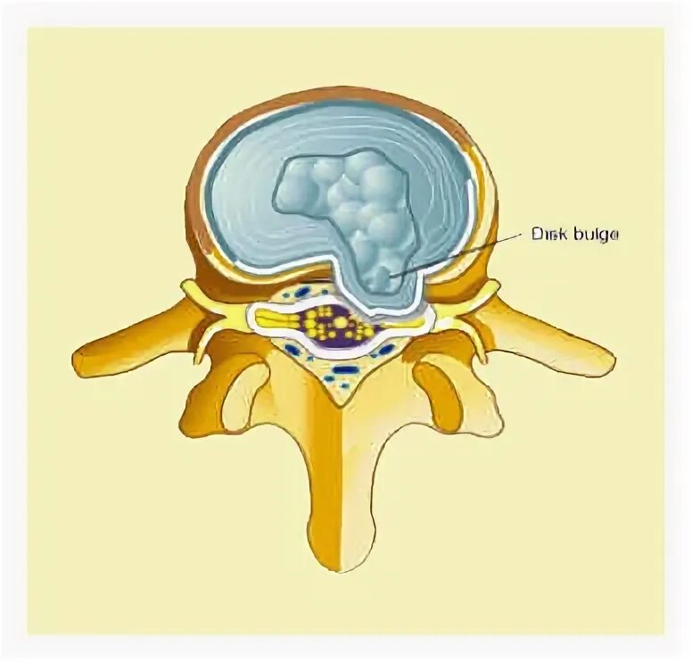 Диффузное выбухание межпозвоночного. Протрузии l4 l5. Секвестрированная грыжа l3-4. Протрузия диска l5-l6. Медианная протрузия дисков позвоночника что это такое.