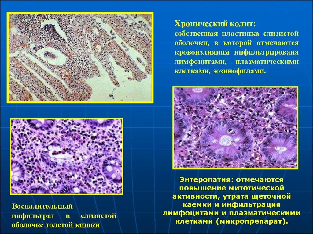 Лимфоидная инфильтрация что это. Хронический колит гистология. Эозинофильный энтерит гистология. Лимфоцитарный колит гистология. Лимфоидной инфильтрации тканей.