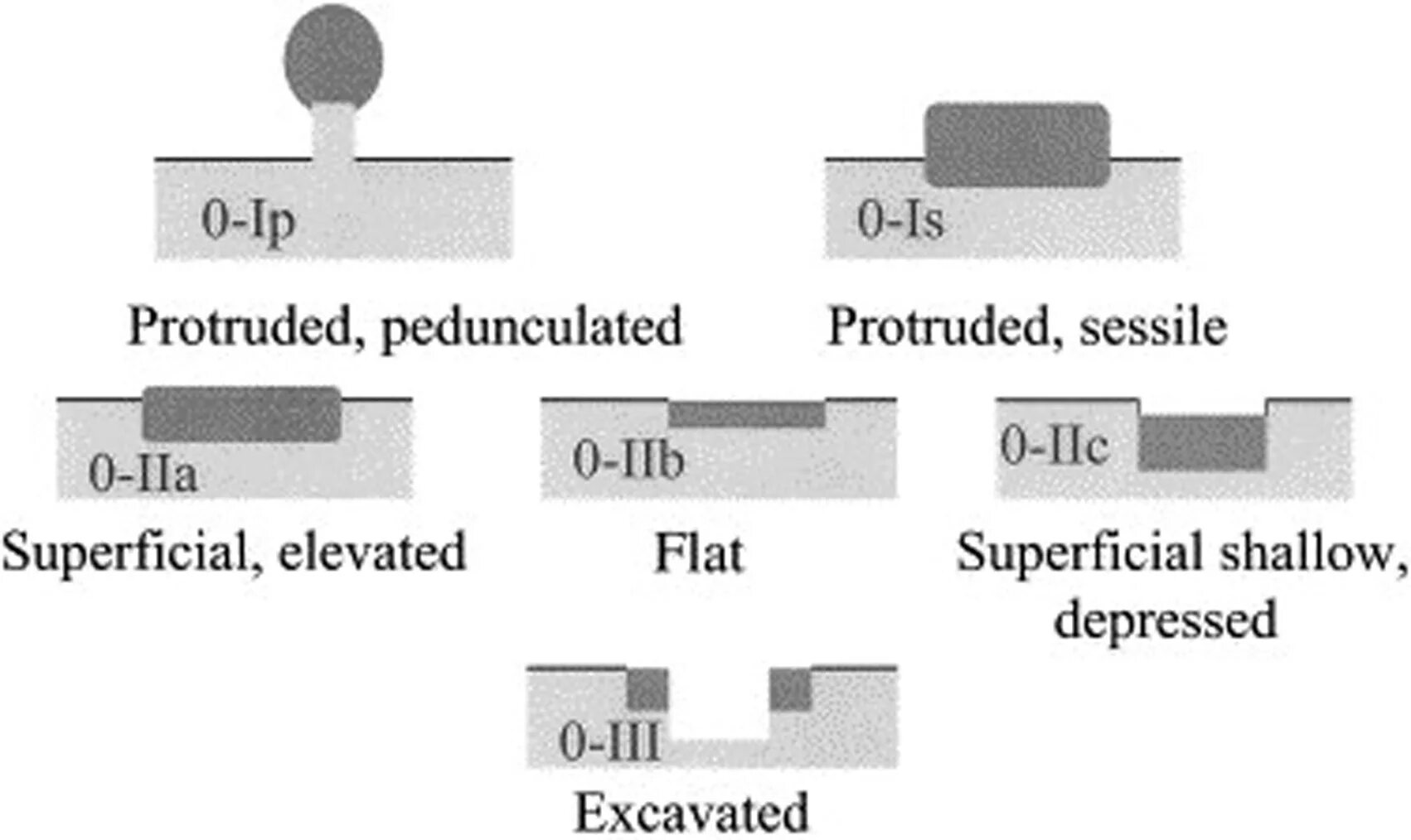 Эндоскопическая классификация полипов. Эндоскопическая классификация полипов. Классификация полипов желудка эндоскопическая. Классификация полипов толстой. Гиперпластический полип толстой кишки микровезикулярно-зубчатый k63.