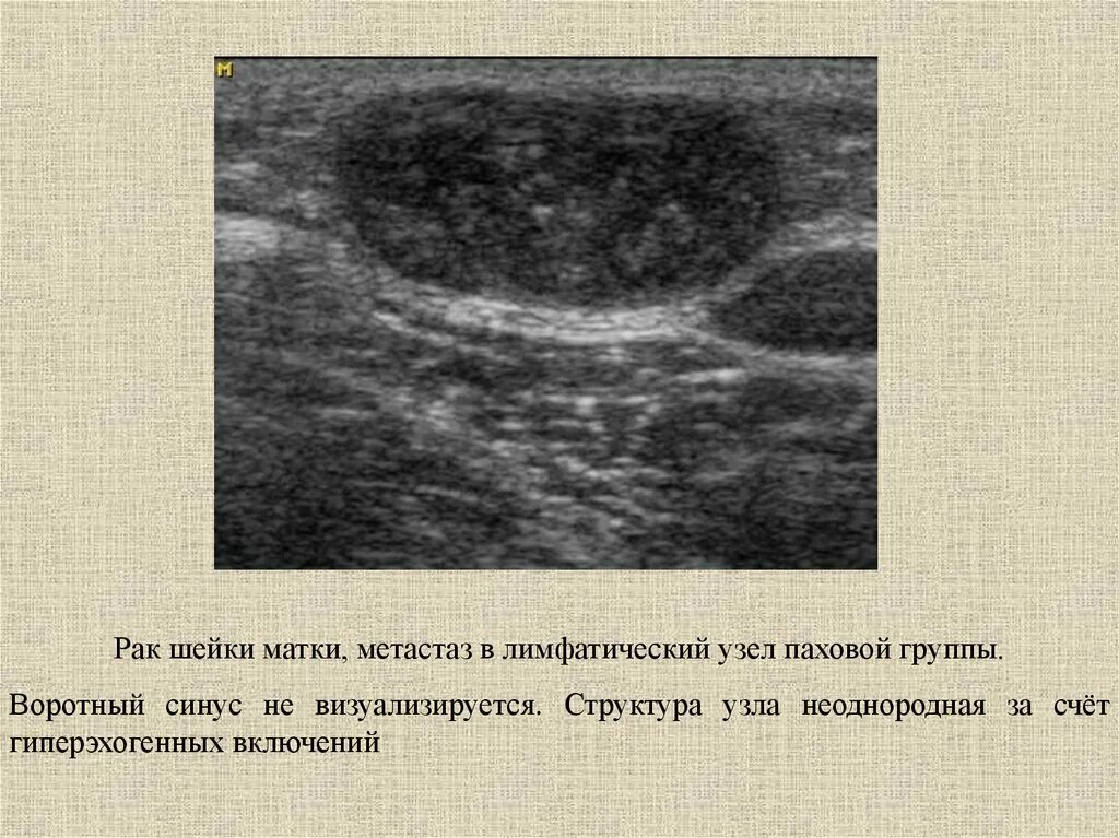 Лимфоузел неоднородный. Структура лимфоузла на УЗИ. УЗИ паховых лимфоузлов. Ультразвуковое исследование лимфоузлов в онкологии.