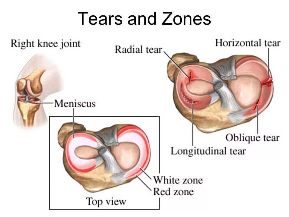 Разрыв мениска коленного сустава. Строение внутреннего мениска коленного сустава. Обрыв мениска коленного сустава. Разрыв мениска коленного сустава симптомы. Поврежденный мениск коленного сустава