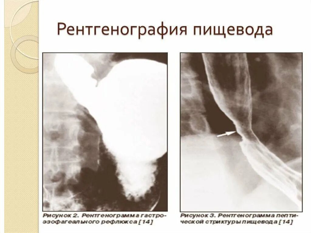 Рентген с барием пищевода и желудка подготовка. Стриктура пищевода рентген. Рентген пищевода при ГЭРБ. Рефлюкс эзофагит пищевода рентген.