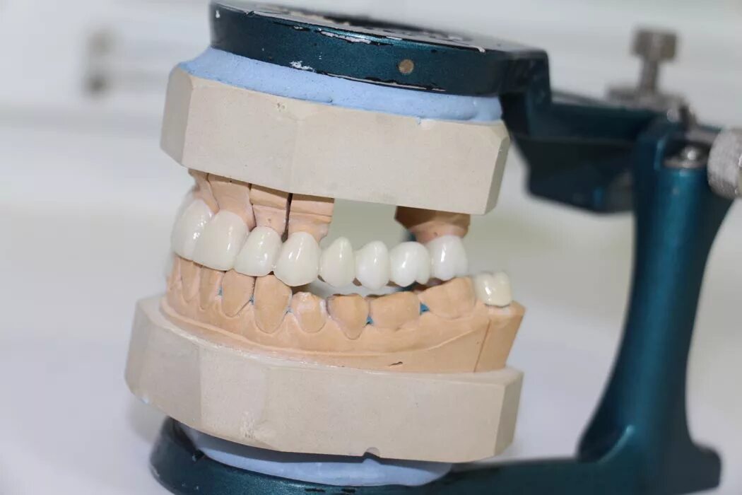 Несъёмный мостовидный протез челюсти. Артикулятор цельнолитого мостовидного протеза. Несъемный мостовидный протез. Мостовидный зубной несъемный протез. Как называется протезист