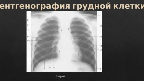 Рентген грудной клетки у детей