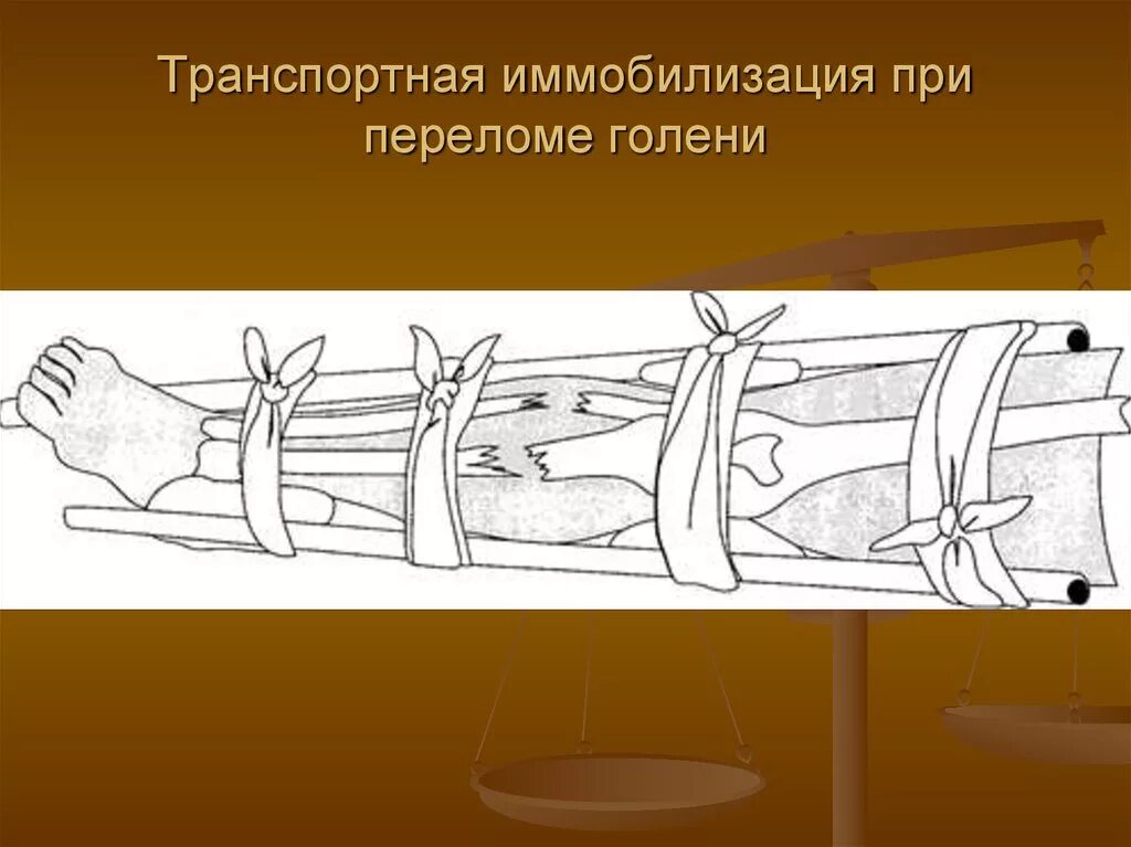 Перелом берцовой кости иммобилизация. Иммобилизация при переломе костей голени. Открытый перелом голени иммобилизация. Иммобилизационная шина при переломе голени. При открытом переломе накладывают