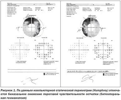 Компьютерная периметрия что это такое