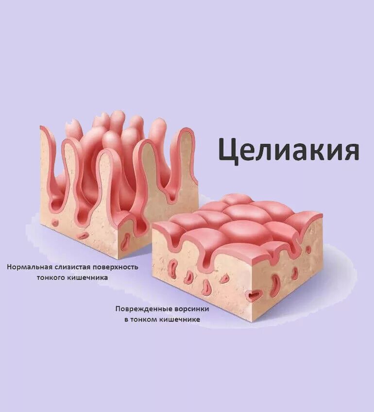 Экссудативная энтеропатия патогенез. Непереносимость глютена. Непереносимость глютена патогенез. Синдром глюкозо-галактозной мальабсорбции что это такое симптомы. Центр целиакии.