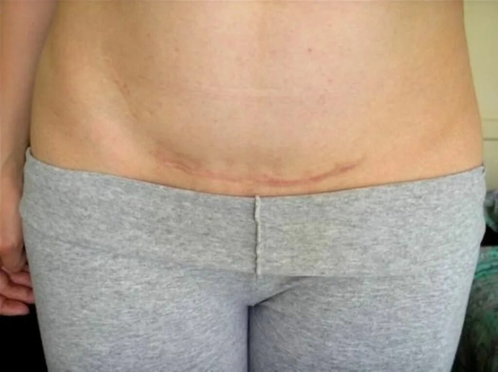 Половая жизнь после кесарева через сколько можно. Рекомендации после кесарева. Размеры матки после кесарева сечения норма по дням. Статистика кесарева сечения. Живот после кесарево сечения.