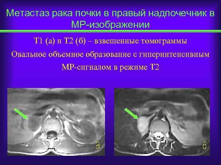 Метастаз надпочечника на кт. Опухоль почки рентгенология. Объемное образование надпочечника на УЗИ.