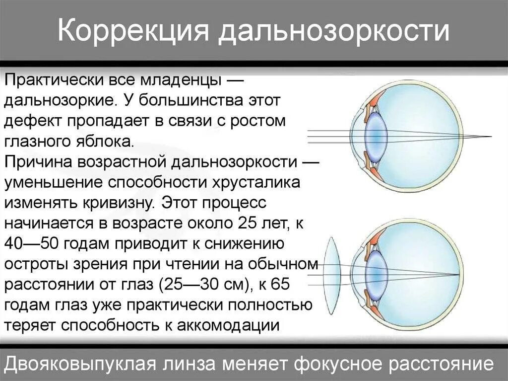 Гиперметропия средней степени глаза. Патология рефракции гиперметропия. Аномалии рефракции глаза близорукость дальнозоркость таблица. Гиперметропия клинические рекомендации 2022. Коррекция пресбиопии при близорукости.