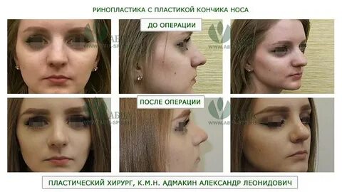 Отзывы после ринопластики форум
