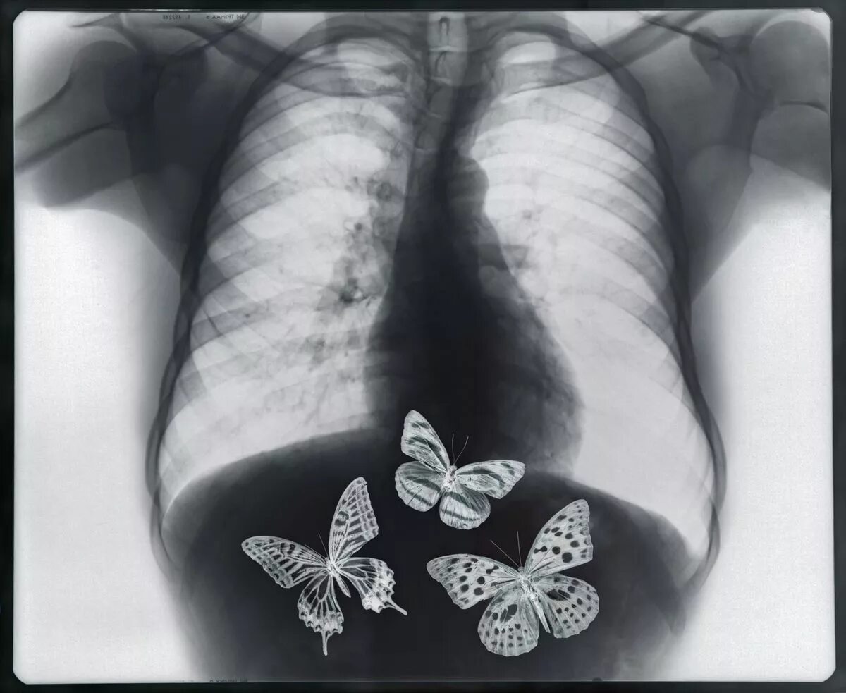 Бабочки в животе. Снимок бабочки в животе. Бабочки в животе рисунок. Бабочки в животе рентген. Бабочки в животе кто поет