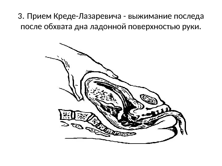 Метод креде-лазаревича выделения последа. Методы выделения последа. Методы выделения последа метод гентера. Способ абуладзе отделения последа. Способы выделения последа.