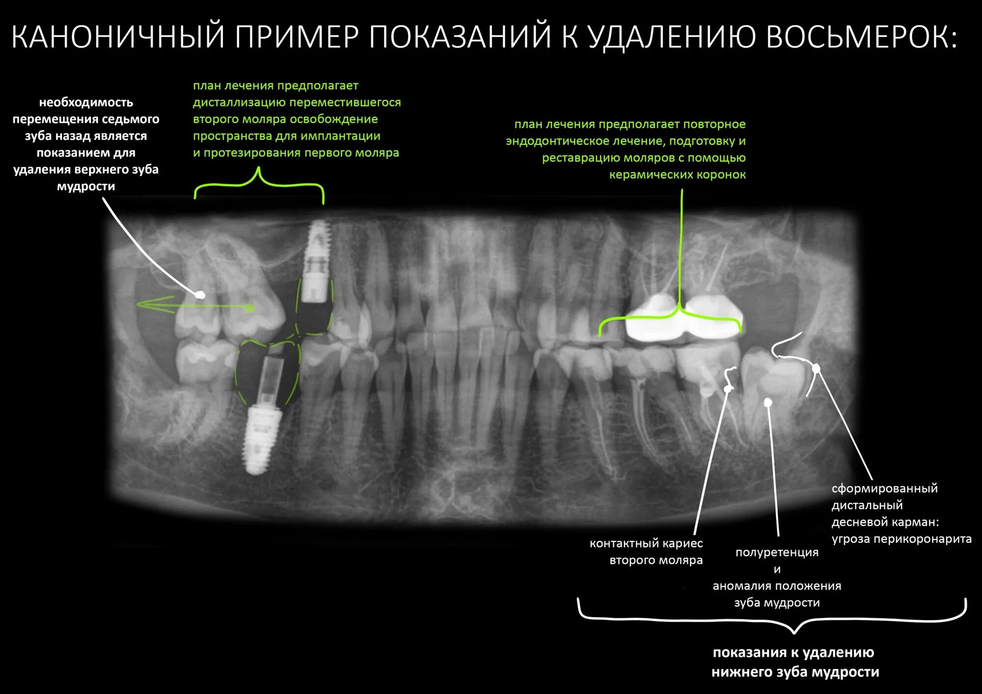 Пить ли антибиотики после удаления зуба мудрости. Показания к удалению зубов мудрости. Удаление зуба мудрости операция.