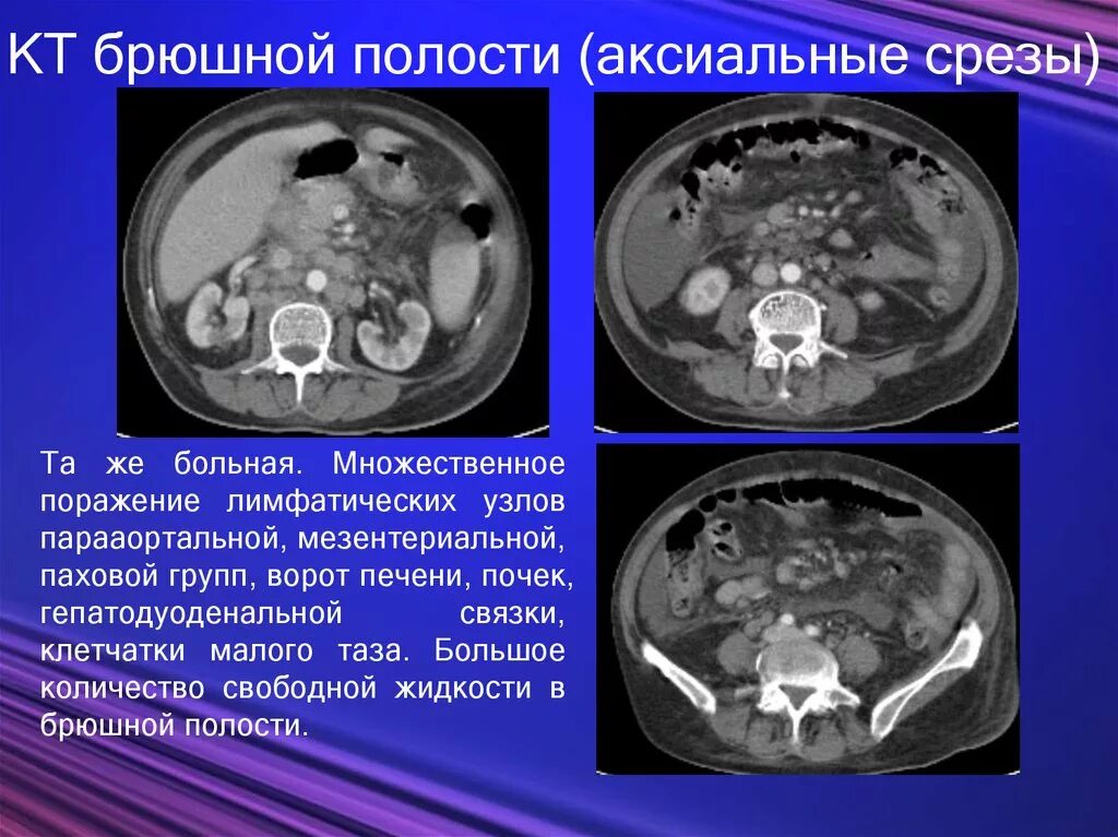 Кт брюшной полости поперечный срез. Кт брюшной полости аксиальный срез. Кт малого таза аксиальный срез. Жидкость в брюшной полости на кт.