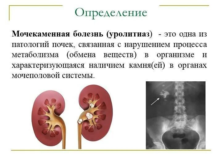 Причины мочекаменного заболевания. Мочекаменная болезнь (уролитиаз). Основные клинические проявления мочекаменной болезни. Блок почки при мочекаменной болезни. Мочекаменная болезнь классификация клиника.