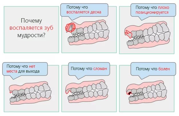 Во сколько вылезают зубы мудрости. Неправильное положение зуба мудрости.