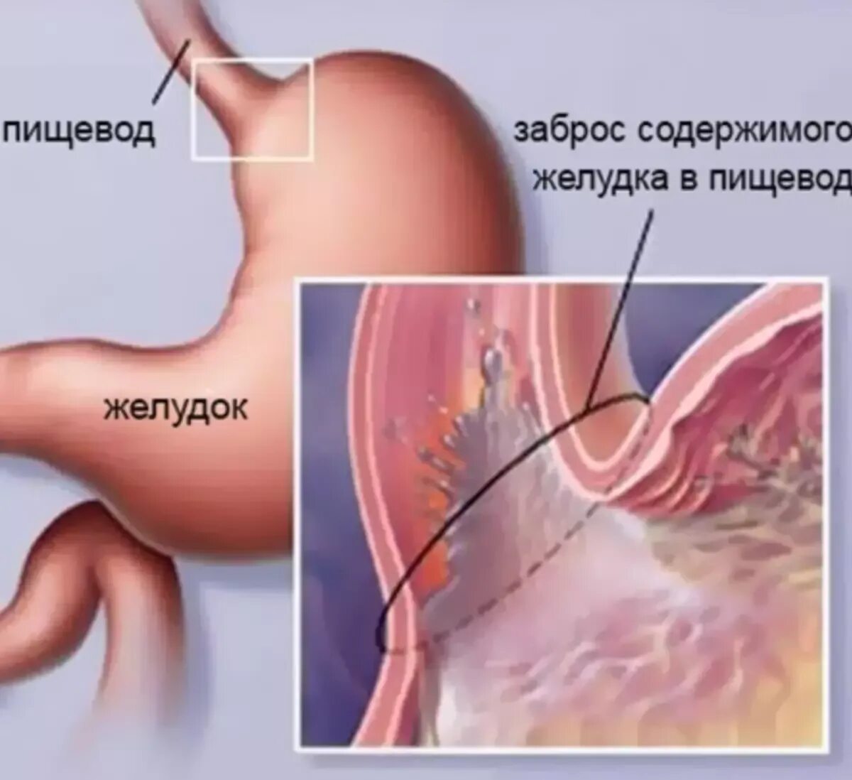 Желудочный сок в пищеводе