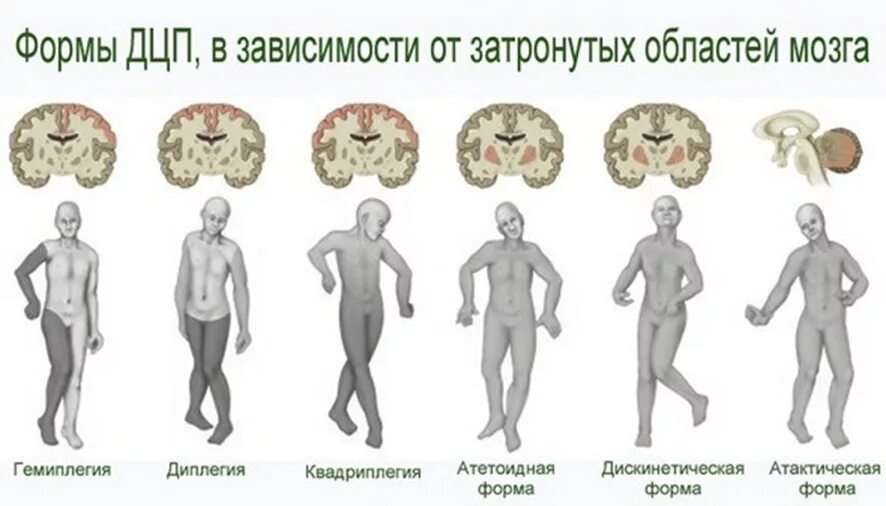 Легкая форма дцп. Клинические формы ДЦП У детей. Формы ДЦП гемиплегия диплегия. Дискинетическая форма при ДЦП У детей. Типы походки при ДЦП.