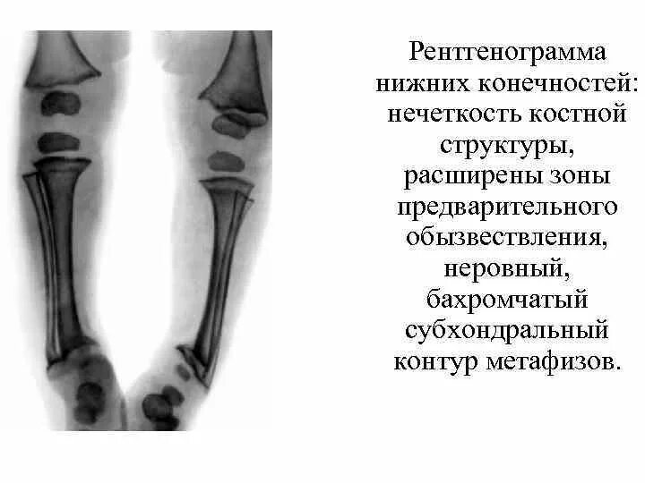Рентгенограмма нижних конечностей.
