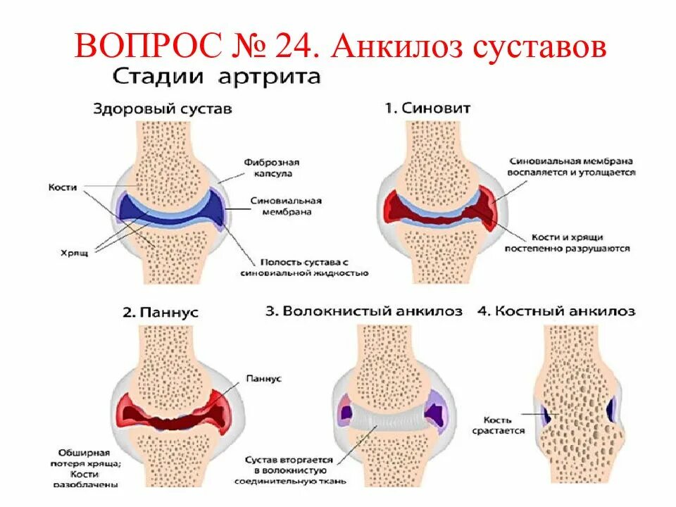 Ревматоидный артрит анкилоз. Костный анкилоз в суставе. Что такое анкилоз суставов при ревматоидном артрите. Типы артритов