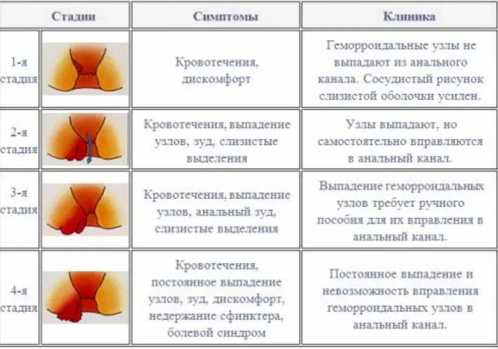 Как быстро вылечить геморрой у женщин. Геморрой наружный узел при беременности. геморрой начальной стадии наружные узлы. геморрой 4 стадии при беременности.