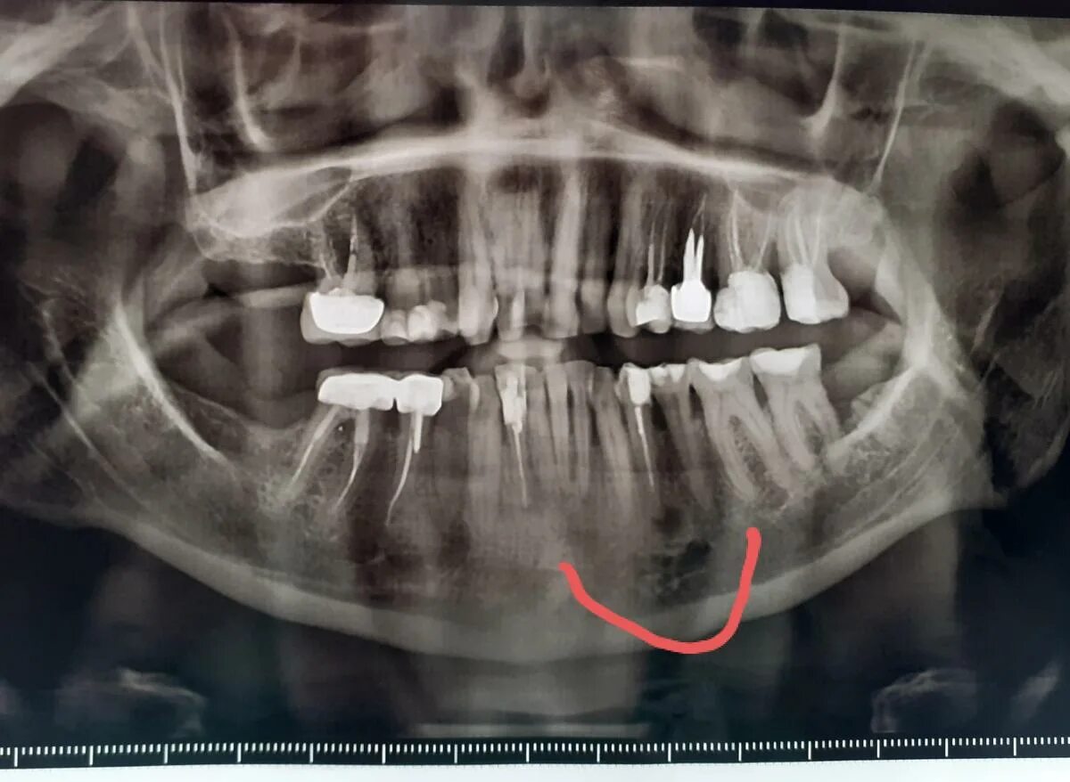 Снимок зубов видное. Панорамный снимок зубов. Панорамные снимки зубов. Рентген панорамный снимок зубов.