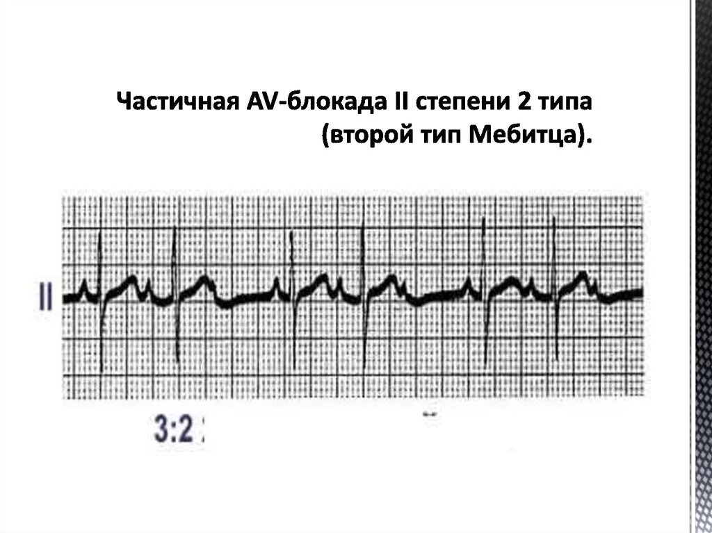 Са блокада 1 степени. АВ блокада 2 степени 2 типа. Атриовентрикулярная блокада 1 степени у собак. Синоатриальная блокада 2 степени 1 типа. Av блокада.